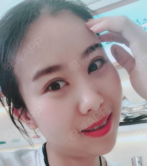 眼睛一點(diǎn)點(diǎn)恢復(fù)，越來越好看 眼部多項(xiàng)手術(shù)的蛻變之旅